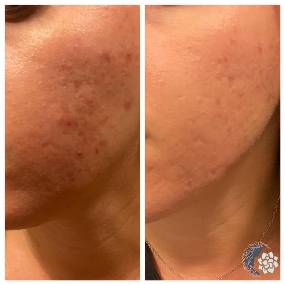 Acne clearing before and after